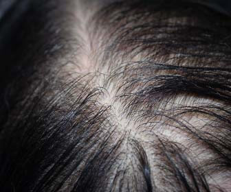 alopecia androgenética femenina