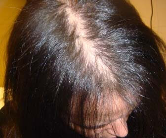 Alopecia Androgénica Femenina