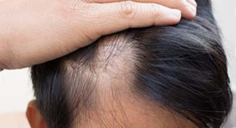 Causas de la alopecia areata femenina