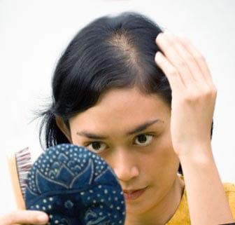 Que es la alopecia difusa femenina