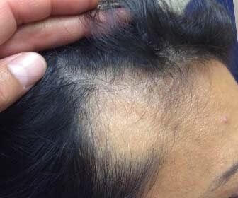 Alopecia Femenina Areata