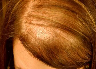 alopecia femenina difusa