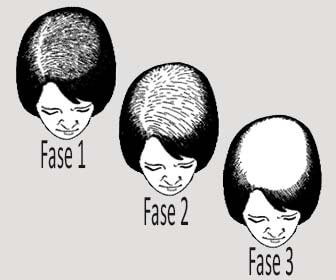 Detectar la alopecia androgénica femenina