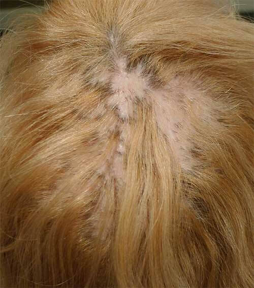 Alopecia-cicatricial