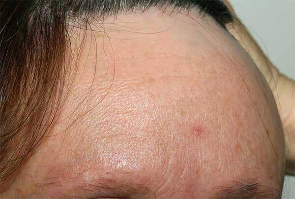 alopecia-femenina-frontal