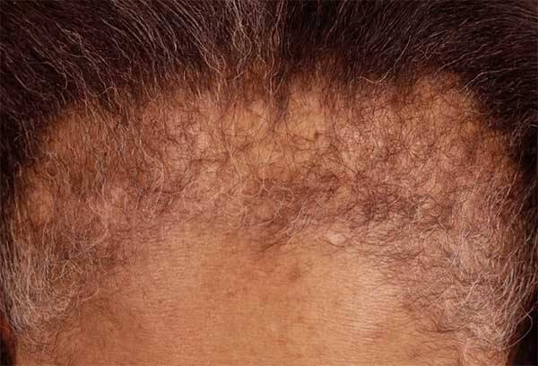 alopecia-fibrosante-frontal-femenina