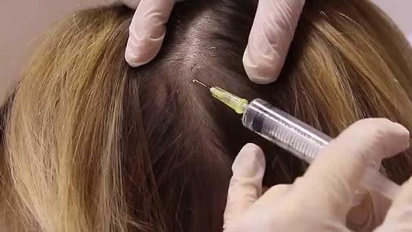 La mesoterapia capilar